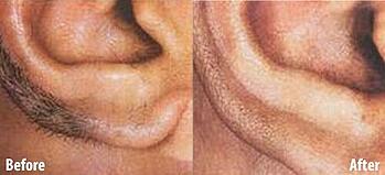 Laser Hair Removal (LHR)